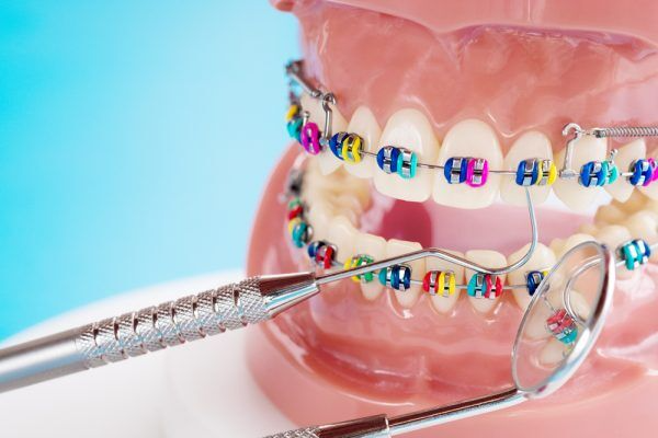 Invisalign Vs. Traditional Braces: Which Is Right For You?